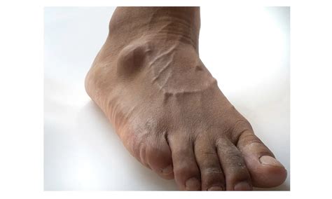 Effective Management of Ganglion Cysts on the Foot at Acacia Foot and ...
