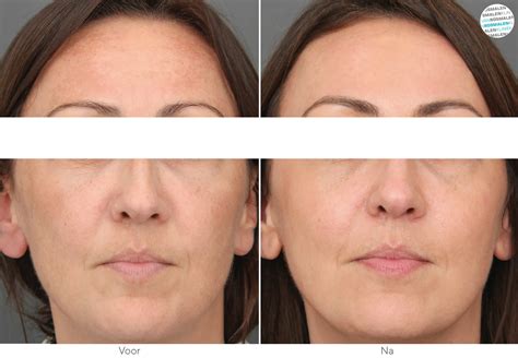 Melasma Pregnancy Mask