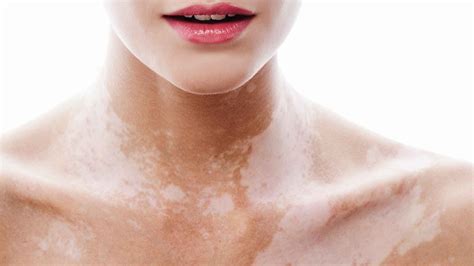 6 Differences between Vitiligo and Leucoderma - Unite For Vitiligo