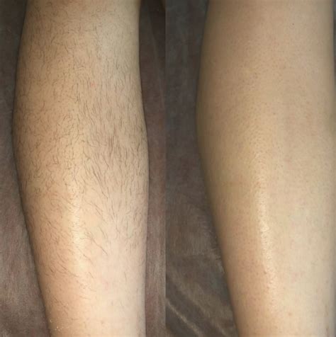 How to prepare for laser hair removal?