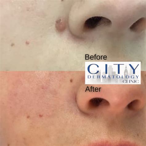 Mole Removal On Face