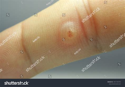 Viral Warts Cryotherapy Blisters On First库存照片1951745755 | Shutterstock