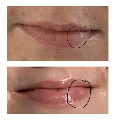 What is this white spot on my bottom lip? I've had it for as long as I can remember : r/beauty