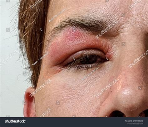 Eyes Man Suffering Herpes Zoster Illness Stock Photo 2467768201 ...