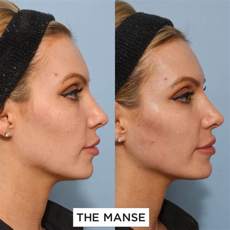 Jawline Dermal Filler - Best Clinic Sydney for Dermal Fillers