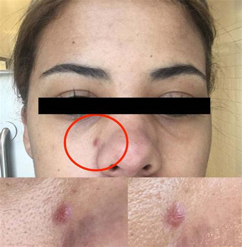 [Acne] Help!!! How do you pop an unpoppable, hard pimple that's been on your face for days? : r ...