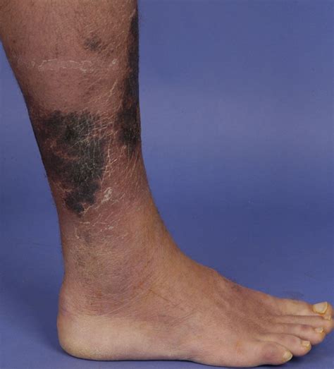 Necrotizing Fasciitis: Symptoms, Diagnosis, and Treatment