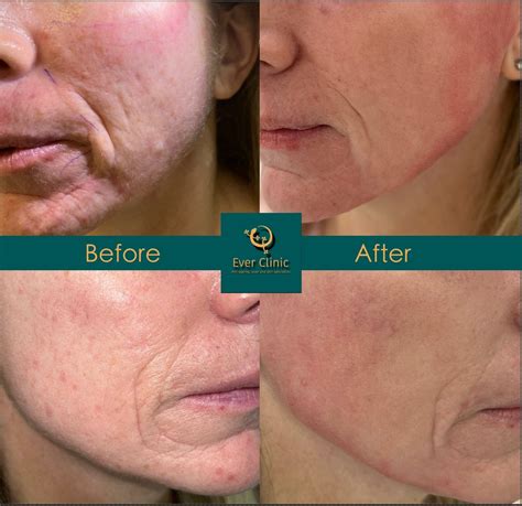 CO2 Laser Skin Resurfacing Glasgow | Fractional CO2 Laser
