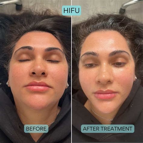 HIFU Before & After | Results | Vie Aesthetics