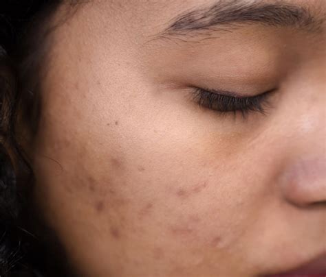 Acne Scarring - Canterbury Dermatology & Laser Clinic