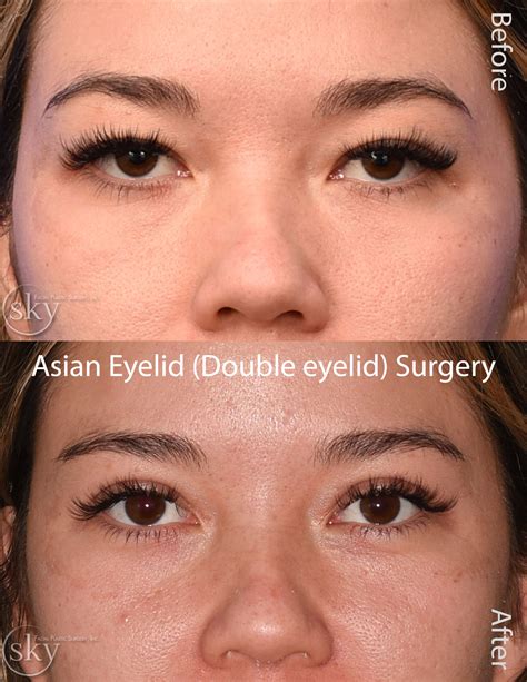Double Eyelid Surgery