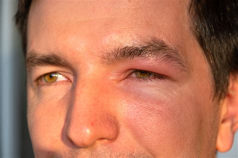 Swollen Eyelid Treatment: Causes, Symptoms, and Best Relief Methods