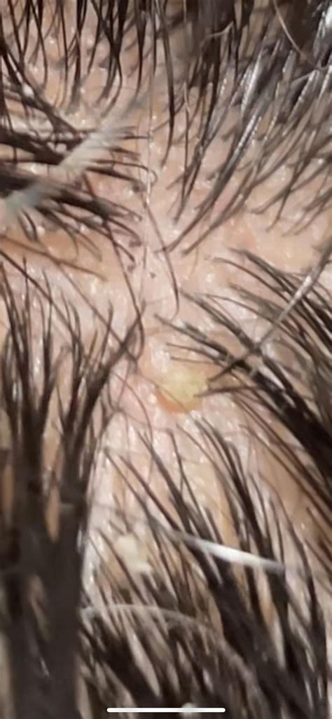 Now ive seen weird things on my head this is no exception. It feels like it hurts randomly like ...