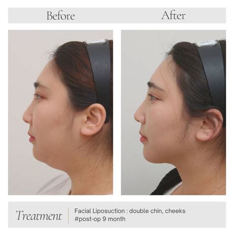 Considering Double Chin Surgery? Know Your 3 possible options - Fresh Clinic Seoul