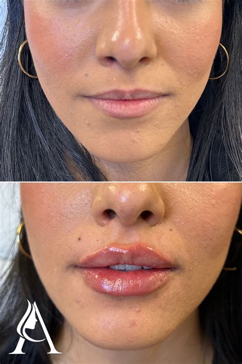 Lip injection before after gallery – Artofit