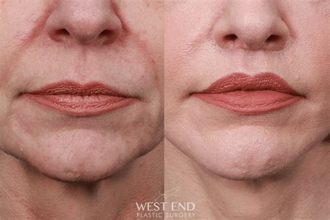 Lip Lift Surgery Washington DC - Top Lip Lift Surgeon