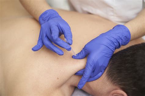 Dry Needling - STAR Physical Therapy
