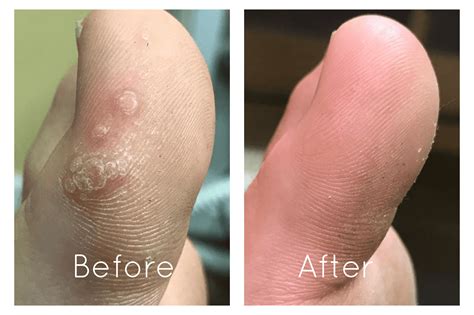 Plantar Wart Between Toes Treatment at Michelle Baldwin blog