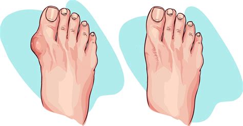 CE Foot and Ankle Clinic - What Is A Bunion?