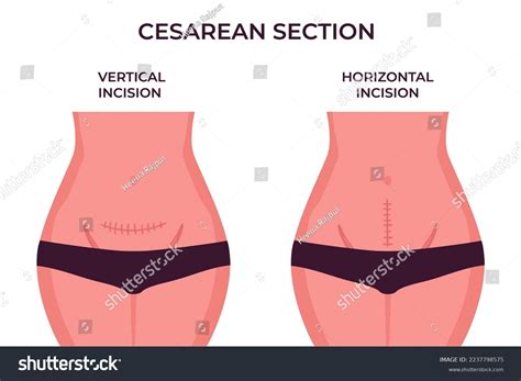 C Section Incision Burning