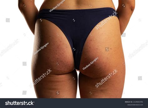 Womans Buttocks Problematic Skin Pimples Cellulite Stock Photo 2129043791 | Shutterstock