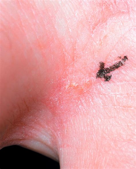 Scabies Burrows Fingers Spanish Academy Of Dermatology And Venereology