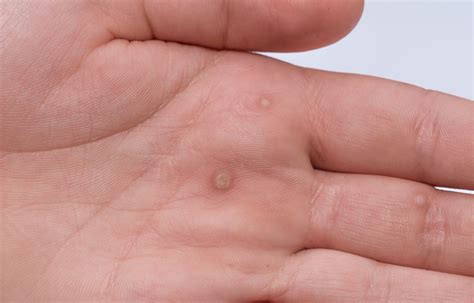 Flat Warts On Hands