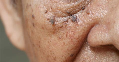 Skin Tag and Wart Removal | Stratum Dermatology Clinics