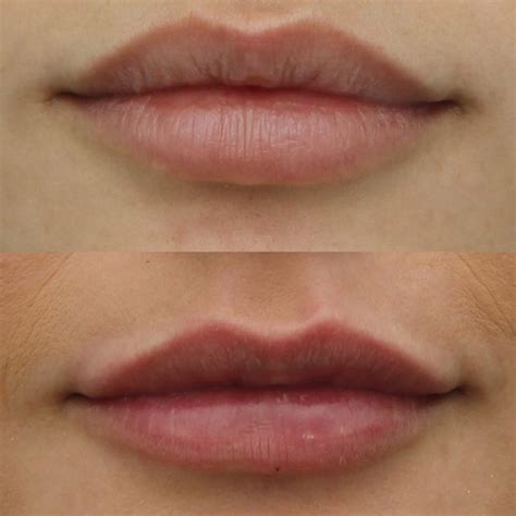 Diy Lip Injections