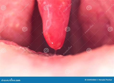 Uvulitis and Sore Throat in the Oral Cavity Due To Illness ...