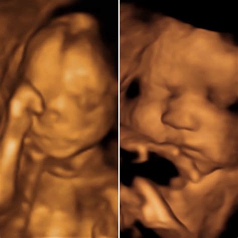 16 Week Ultrasound 3d