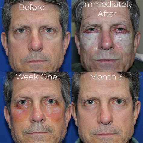 Lower Blepharoplasty in Boulder | Kyle Cox MD Oculofacial Surgery & Aesthetics