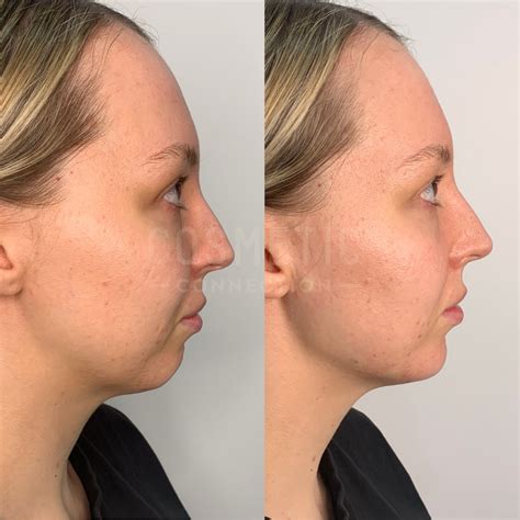 Enhancing Jawline with Jaw Fillers - Cosmetic Connection