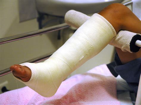 Fracture And Leg Cast at Ila Yeomans blog