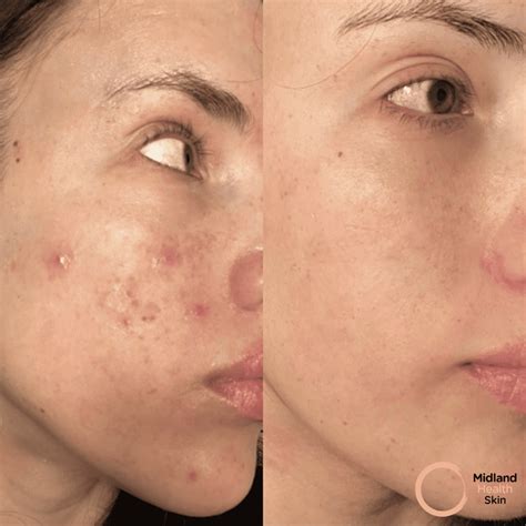IPL Laser Treatment For Active Acne & Rosacea Birmingham - Midland Health
