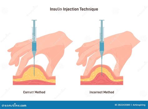 Insulin Injection Technique. Correct And Incorrect Way. Cross-section Vector Illustration ...