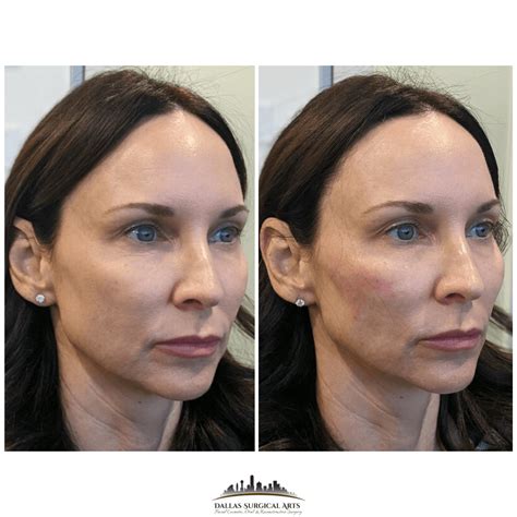 Facial Fillers in Dallas | Dallas Surgical Arts