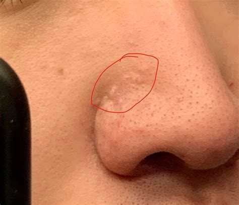 Mysterious bumps on nose for 3+ years! Help! : r/DermatologyQuestions