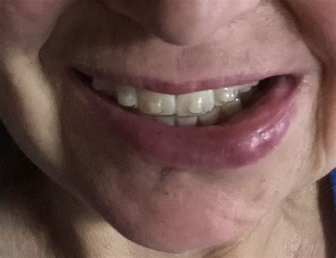 A lower lip swelling of recent onset - The Journal of the American Dental Association