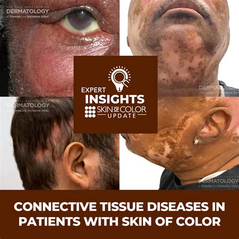 Connective Tissue Diseases in Patients With Skin of Color | Expert ...