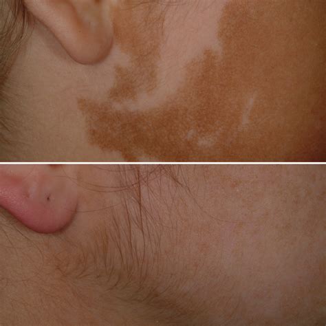 White Spots On Skin Birthmark at Frank White blog