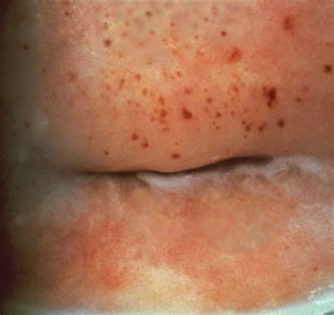 Trichomoniasis Men Symptoms