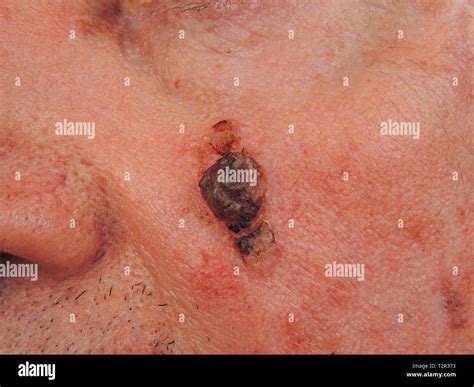 Epidermoid Carcinoma