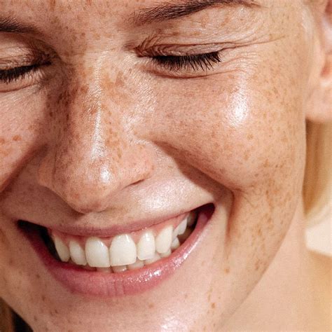 Smile Lines vs Nasolabial Folds: Prevention to Treatment