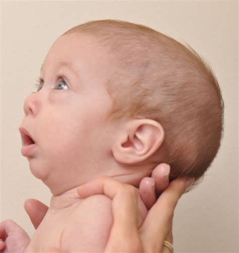 Pierre Robin Sequence (PRS) | Hellenic Craniofacial Center