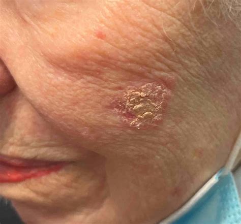 Actinic Keratosis Face