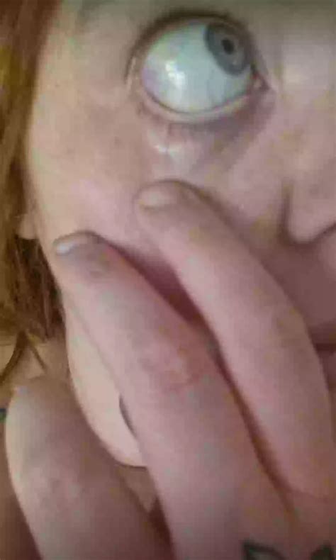 Mum who used Mounjaro had yellow eyes and needing her gallbladder removed