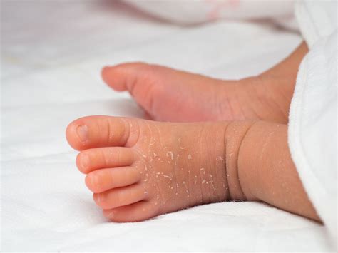 Baby Dry Skin Rash