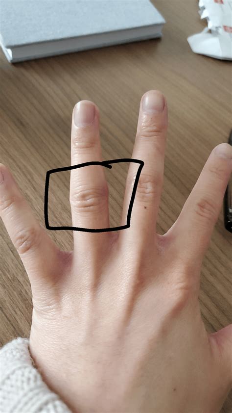 Jammed finger from basketball : r/AskDoctorSmeeee