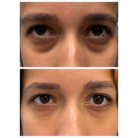 Under Eye Dark Circle Treatment | Non Surgical Blepharoplasty | St. Louis